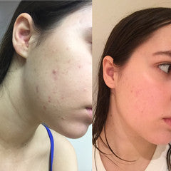 Help at last for breakouts