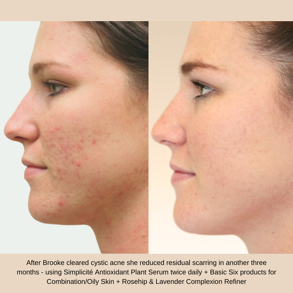 After Brooke cleared cystic acne she reduced residual scarring in another three months - using Simplicité Antioxidant Plant Serum twice daily + Basic Six products for Combination/Oily Skin + Rosehip & Lavender Complexion Refiner