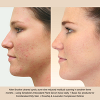 After Brooke cleared cystic acne she reduced residual scarring in another three months - using Simplicité Antioxidant Plant Serum twice daily + Basic Six products for Combination/Oily Skin + Rosehip & Lavender Complexion Refiner
