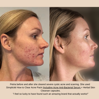 Petria before and after she cleared severe cystic acne and scarring. She used SImplicité Acne Anti-Bacterial Serum + Basic Six products for Combination/Oily Skin + Herbal Skin Cleanser capsules.