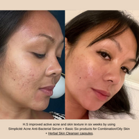 Natural skin care best acne treatment with internal remedy Herbal Skin Cleanser capsules combined with natural skin care acne serum and cleanser, exfoliator