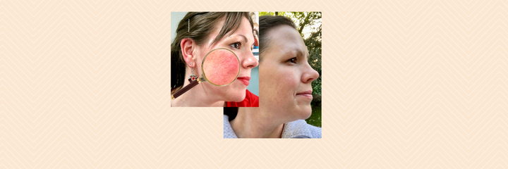 Stunning results for rosacea using natural skin care