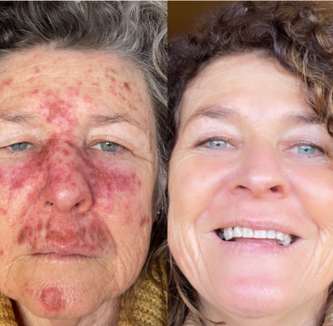 I hated Efudex but through it I found the best effective natural skincare