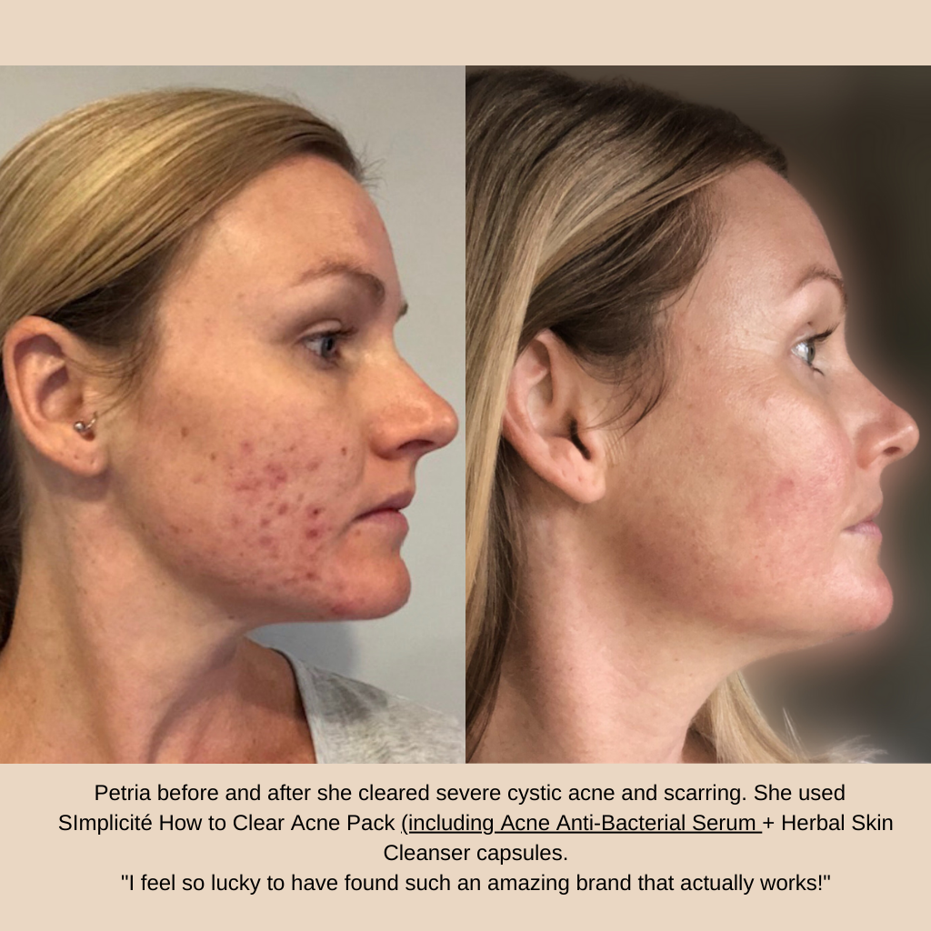Petria before and after she cleared severe cystic acne and scarring. She used  SImplicité Acne Anti-Bacterial Serum + Basic Six products for Combination/Oily Skin + Herbal Skin Cleanser capsules.