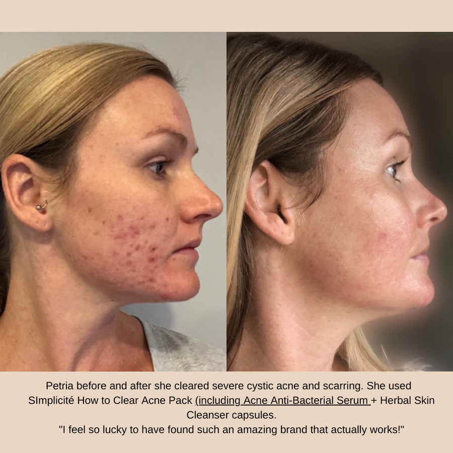 Petria before and after she cleared severe cystic acne and scarring. She used  SImplicité Acne Anti-Bacterial Serum + Basic Six products for Combination/Oily Skin + Herbal Skin Cleanser capsules.