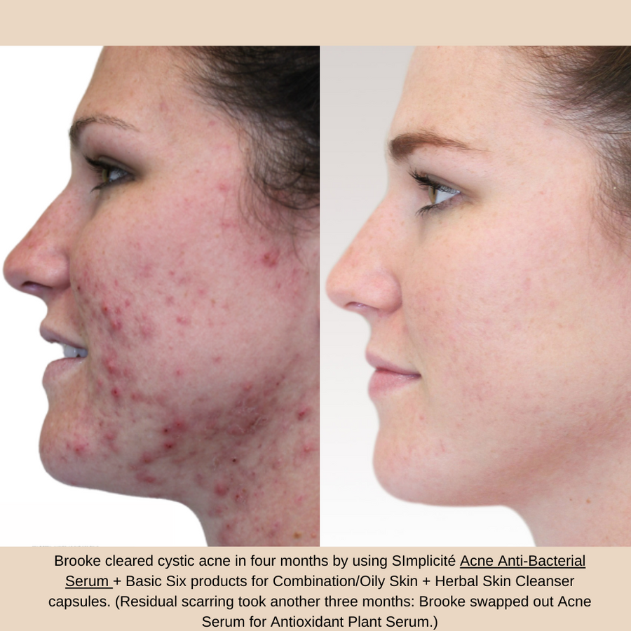 Brooke cleared cystic acne in four months by using SImplicité Acne Anti-Bacterial Serum + Basic Six products for Combination/Oily Skin + Herbal Skin Cleanser capsules.
